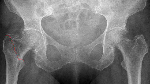 Fractured hip