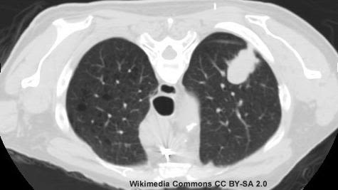 A computed tomography image of the lung