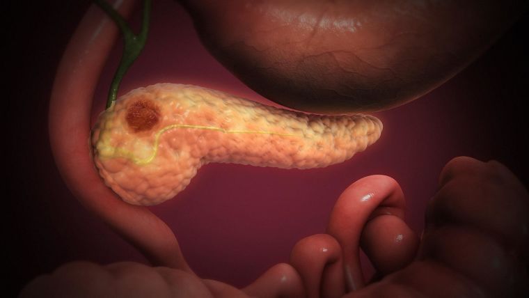 An animated drawing of a pancreas with a red area of cancer.